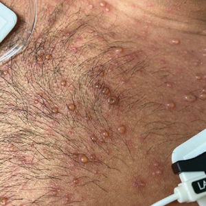 A 26-year-old man with erythematous papules and vesicopustules scattered diffusely on the chest characteristic of varicella-zoster virus.