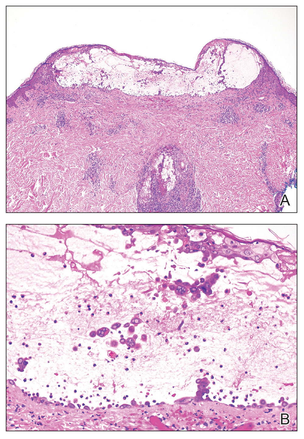 A, Histopathology showed an intraepidermal acantholytic blister (H&E, original magnification ×40). B, High-power view revealed the classic herpetic viral cytopathic effect of multinucleation, chromatin margination, and nuclear molding