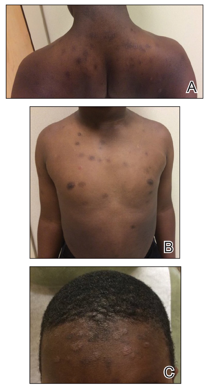 A and B, Scattered hyperpigmented patches, annular hyperpigmented plaques, and erythematous plaques on the posterior neck to the mid back and anterior aspect of the torso