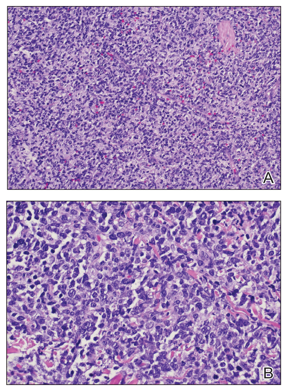 Histopathology demonstrated a pleomorphic cellular dermal infiltrate characterized by atypical lymphoid cells