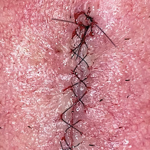 Postoperative wound edge with 5-0 nylon sutures photographed using a 12-megapixel smartphone camera.