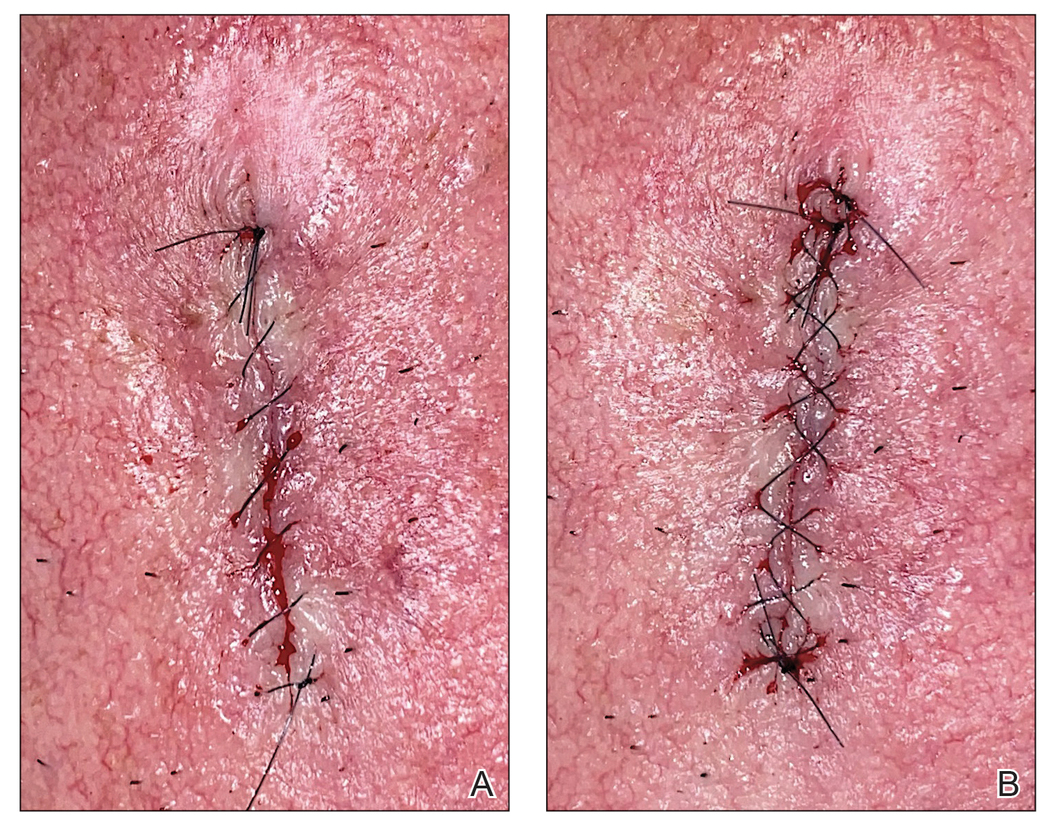 Postoperative wound edge with 5-0 nylon sutures photographed using a 12-megapixel smartphone camera.