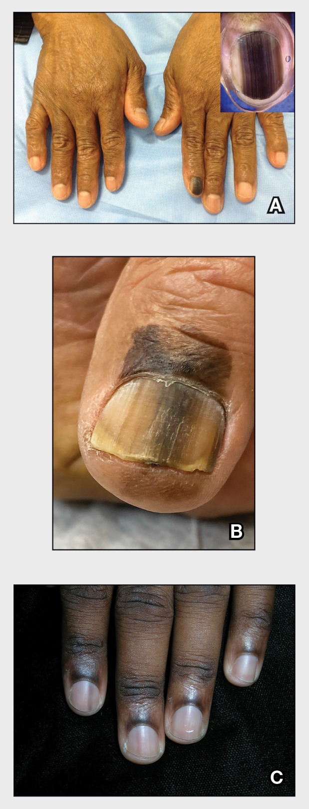 Figure 5 from Tangential excision of pigmented nail matrix lesions  responsible for longitudinal melanonychia: evaluation of the technique on a  series of 30 patients. | Semantic Scholar