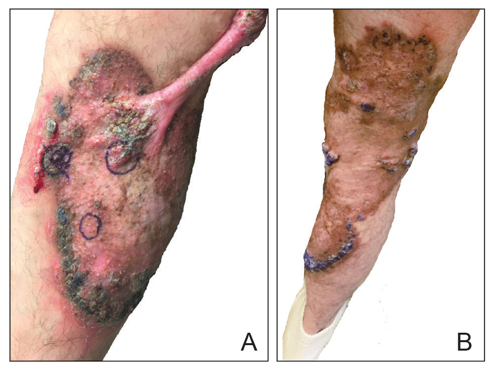 Annular verrucous plaque with central hypopigmentation extending from the medial right leg to the posterior right thigh with keloid formation at the proximal edge. 