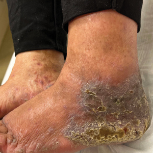 Lichenoid dermatosis on the feet