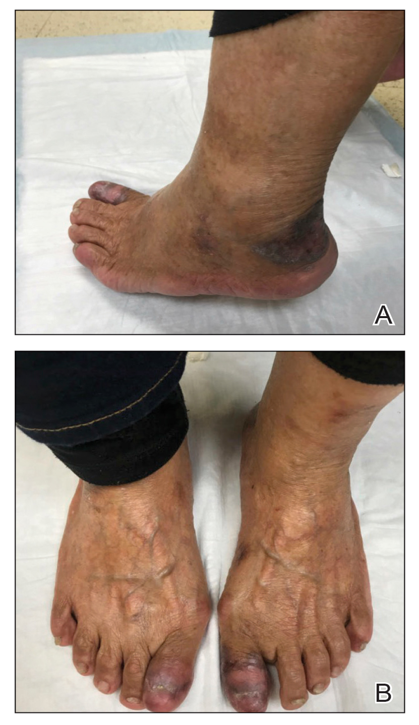 Notable improvement of the lichen planus on the heels and toenails, respectively, was observed following 3 months of treatment with methotrexate.