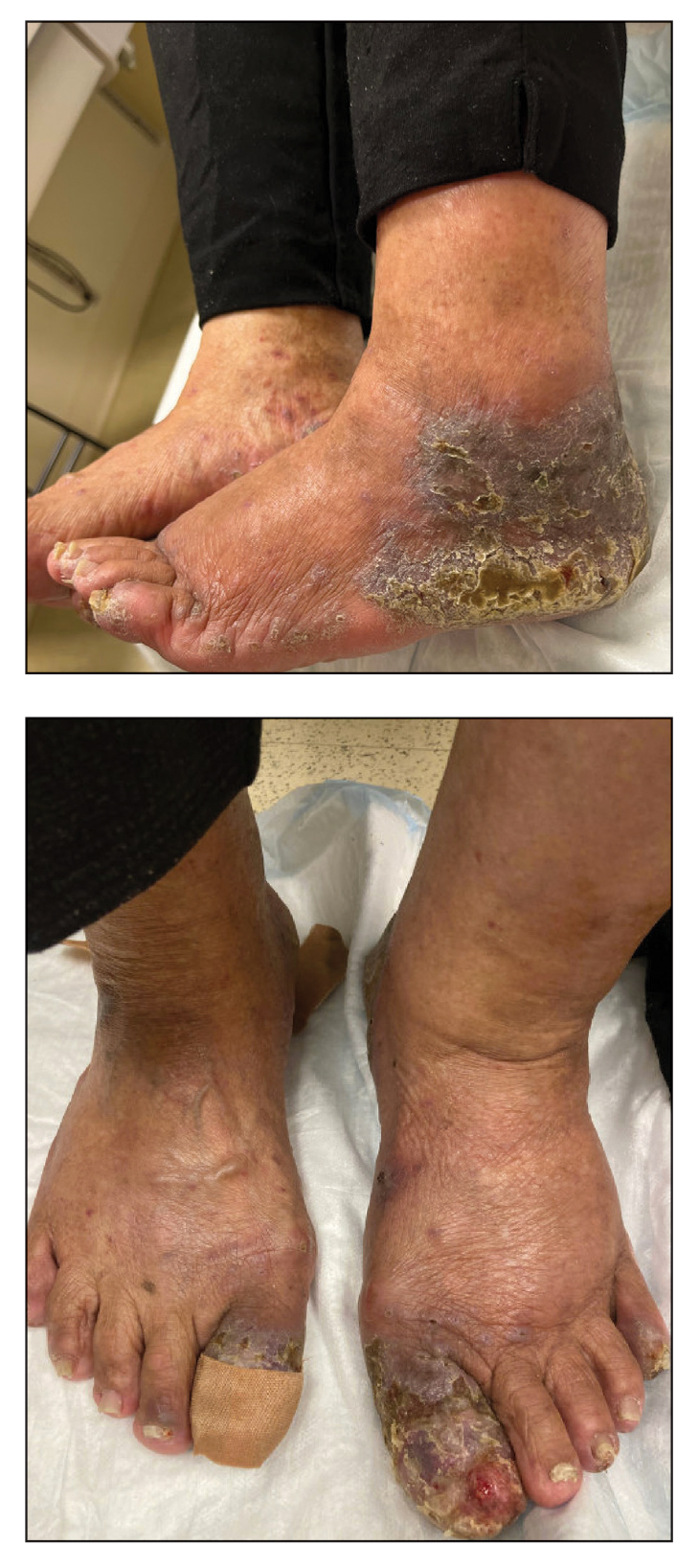 Lichenoid Dermatosis on the Feet | MDedge Dermatology