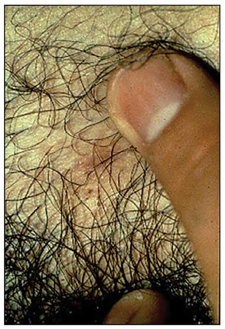 Maculae ceruleae—blue-grey macules—may be present on the skin secondary to Pediculosis infestation.