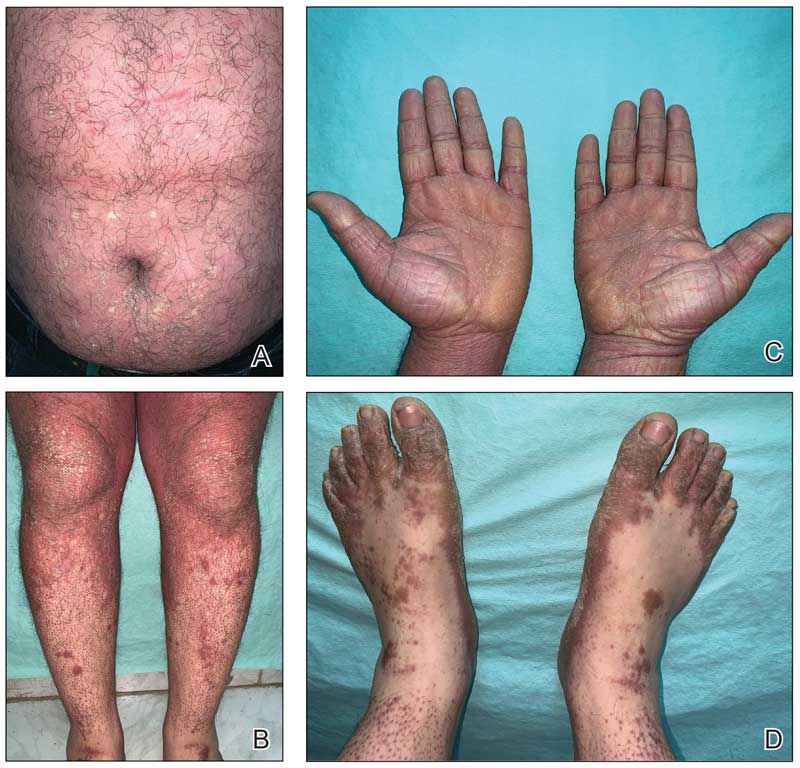 Pityriasis rubra pilaris following the Sinopharm BBIBP COVID-19 vaccine (BBIBP-CorV).