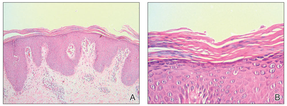 A, Irregular epidermal hyperplasia with thick suprapapillary plates, hypergranulosis, and alternating orthokeratosis and parakeratosis in vertical and horizontal directions. The underlying dermis showed a mild, superficial, perivascular lymphohistiocytic 