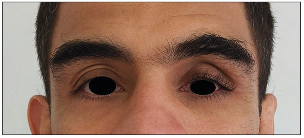 Periorbital hyperpigmentation on the left side; hypertrichosis and eyelash trichomegaly compared to the right side