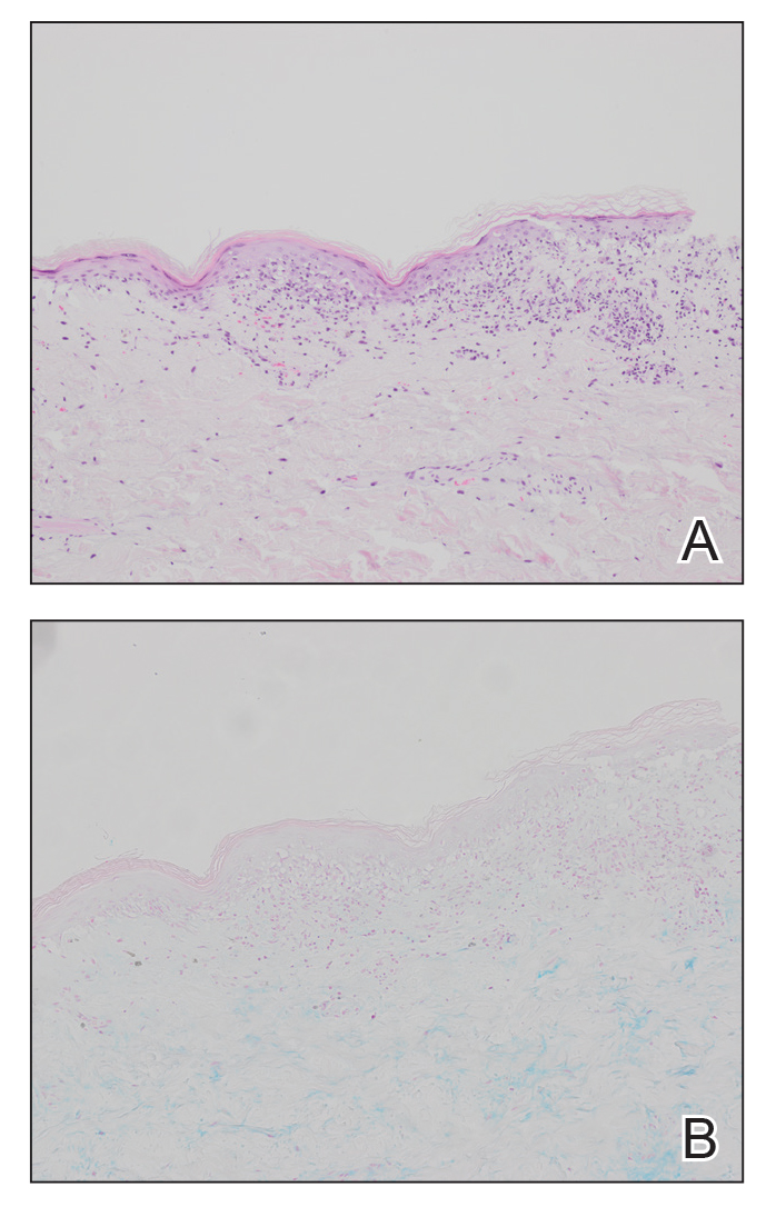 A, Initial biopsy of the back showed vacuolar interface dermatitis and a sparse superficial perivascular lymphocytic infiltrate