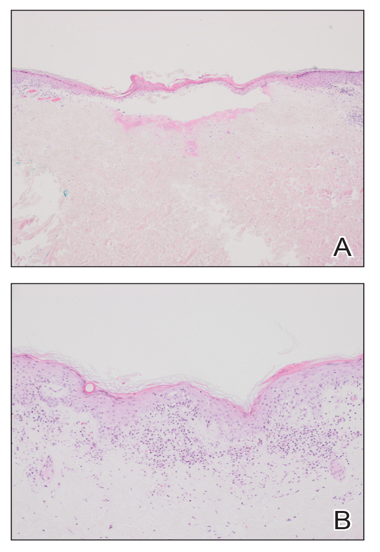 A, A biopsy of a lesion on the abdomen showed central epidermal necrosis and parakeratosis with an underlying wedgeshaped dermal infarct