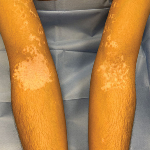 Vitiligo on the patient’s left arm was treated with ruxolitinib over a period of 36 weeks with remarkable repigmentation. In contrast, the patient’s right arm was not treated.