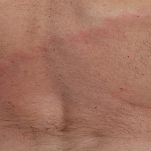 Asymptomatic erythematous plaque in an outdoorsman