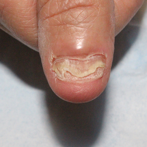 Lichen planus of the thumbnail before application of resin nail.