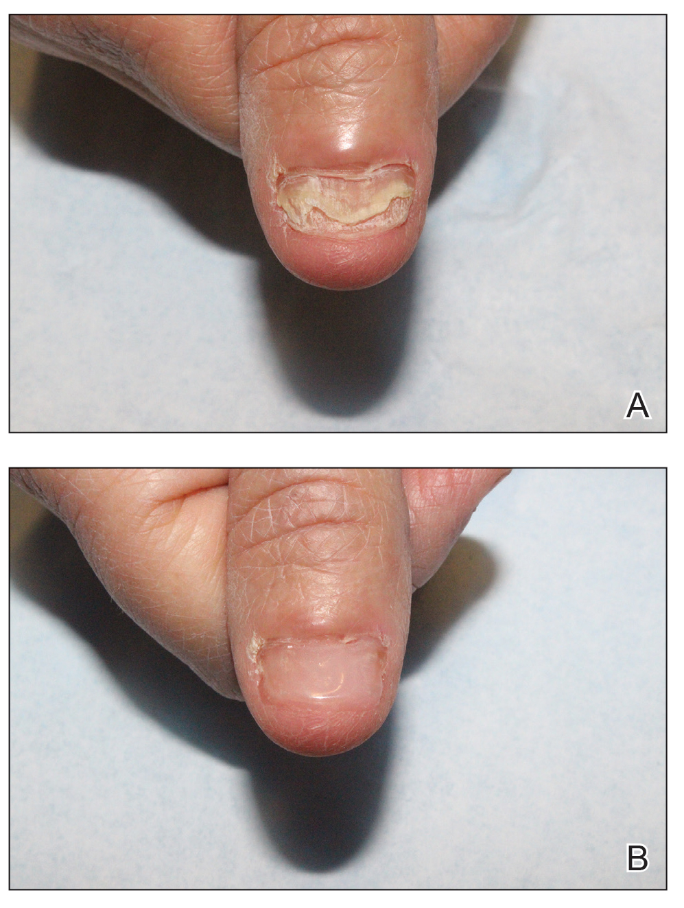 A, Lichen planus of the thumbnail before application of resin nail. B, Fingernail after application of resin nail.