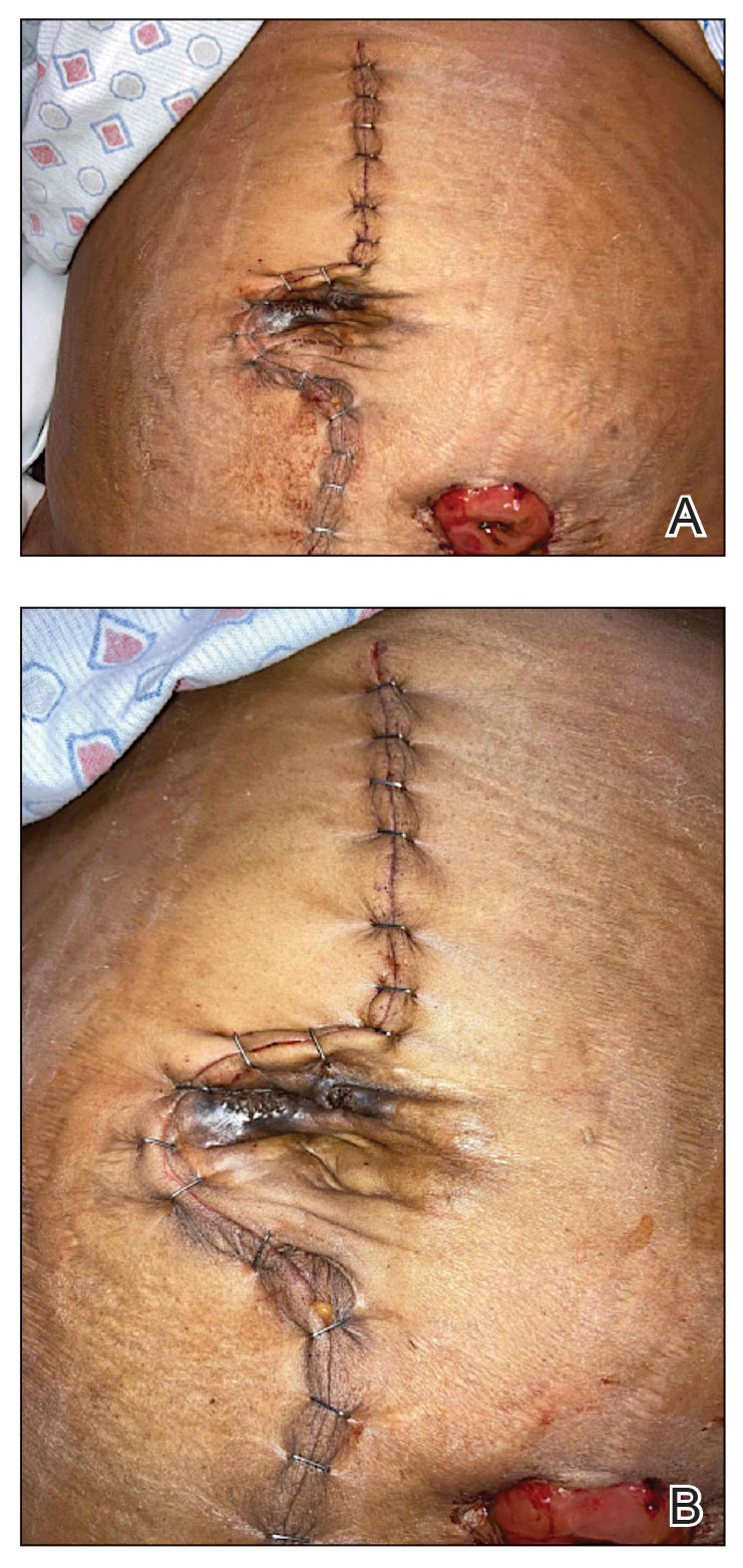 A growing hyperpigmented to violaceous periumbilical plaque with a central hyperkeratotic core that was diagnosed as perforating calcific elastosis in a patient with a history of abdominal surgery.