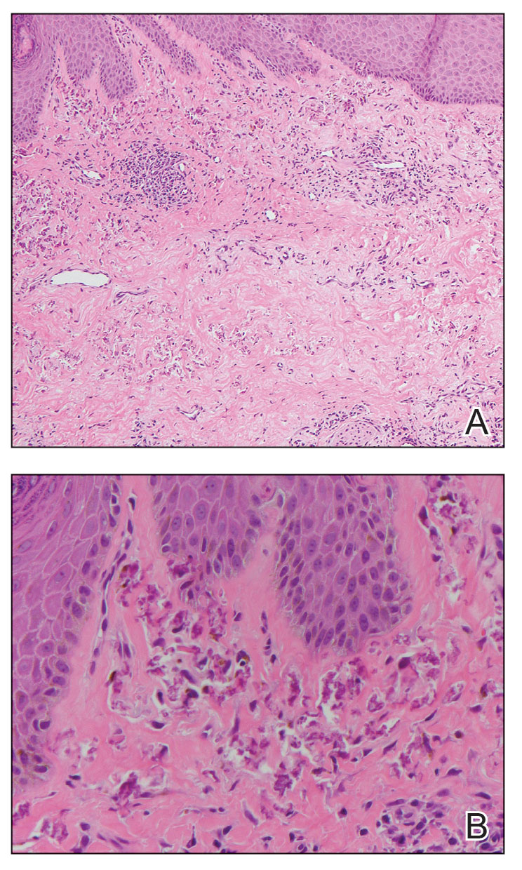 Histopathology showed diffuse dermal collections of degenerated eosinophilic distorted elastic fibers with calcification