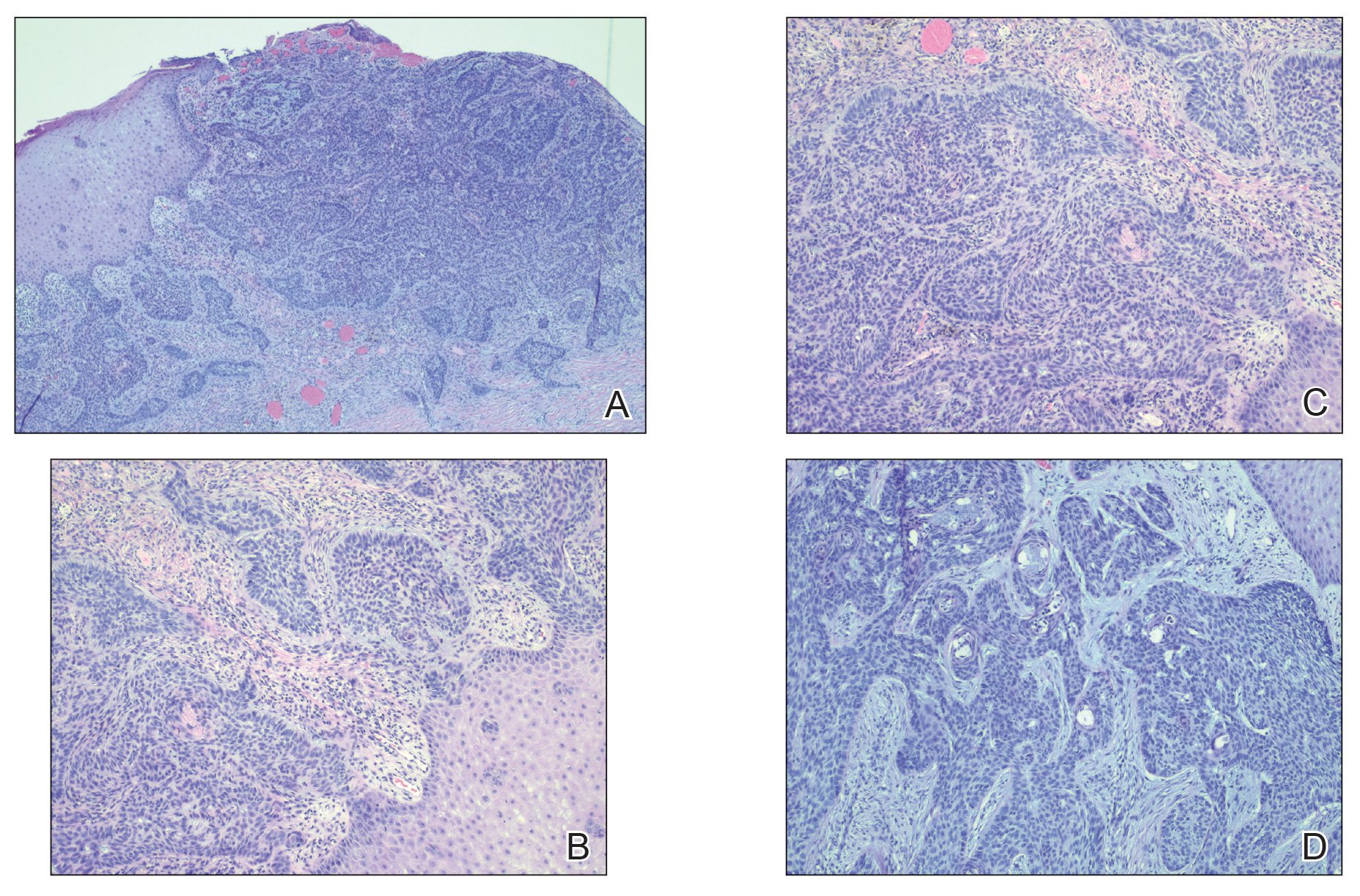 A, Histopathology revealed an ulcerated basal cell carcinoma with a large basaloid lobule showing focal epidermal attachment (H&E, original magnification ×4)