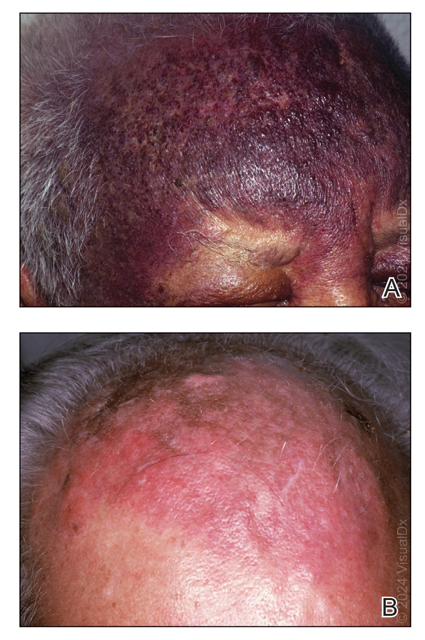 A, An extensive, deeply violaceous plaque with cobblestone appearance in areas on the forehead and a similar plaque on the left upper eyelid. B, An extensive reddish-brownish cutaneous angiosarcoma plaque on the scalp and forehead.