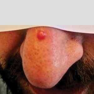 Solitary shiny, 7-mm, pink-red papule on the patient’s nasal dorsum that was diagnosed as nonepidemic Kaposi sarcoma.