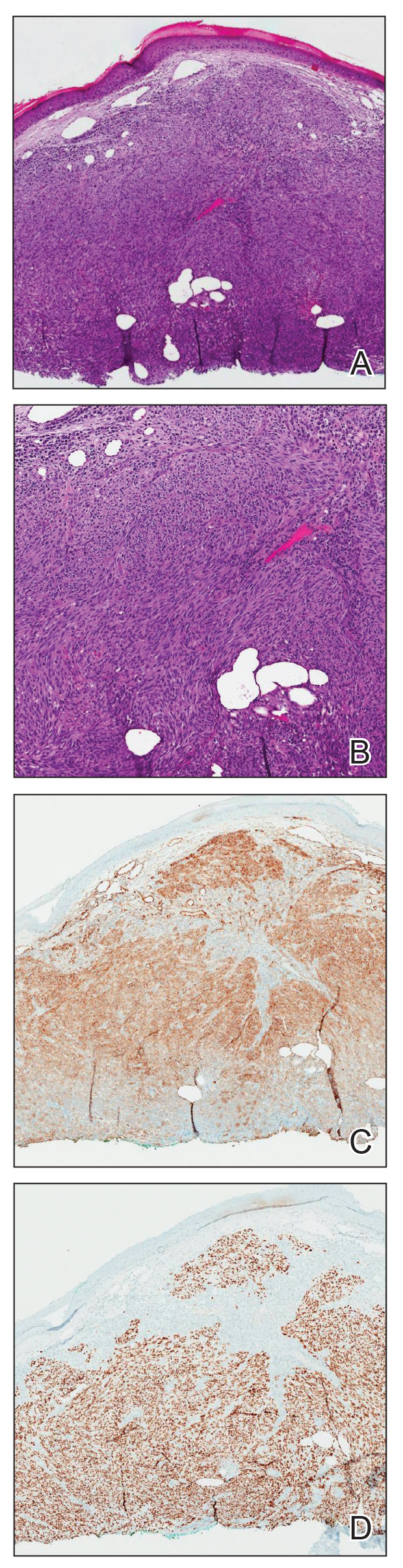 Histopathology of Kaposi sarcoma