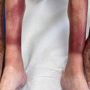 Photoexposed rash in an older adult