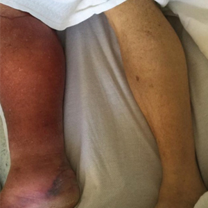 A demarcated erythematous rash on the right lower leg extending to the knee with marked swelling of the right calf and foot.