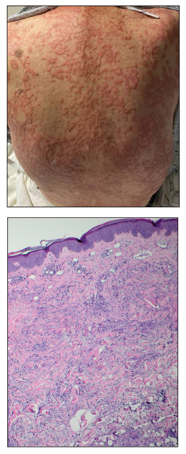 Annular Erythematous Plaques on the Back | MDedge Dermatology