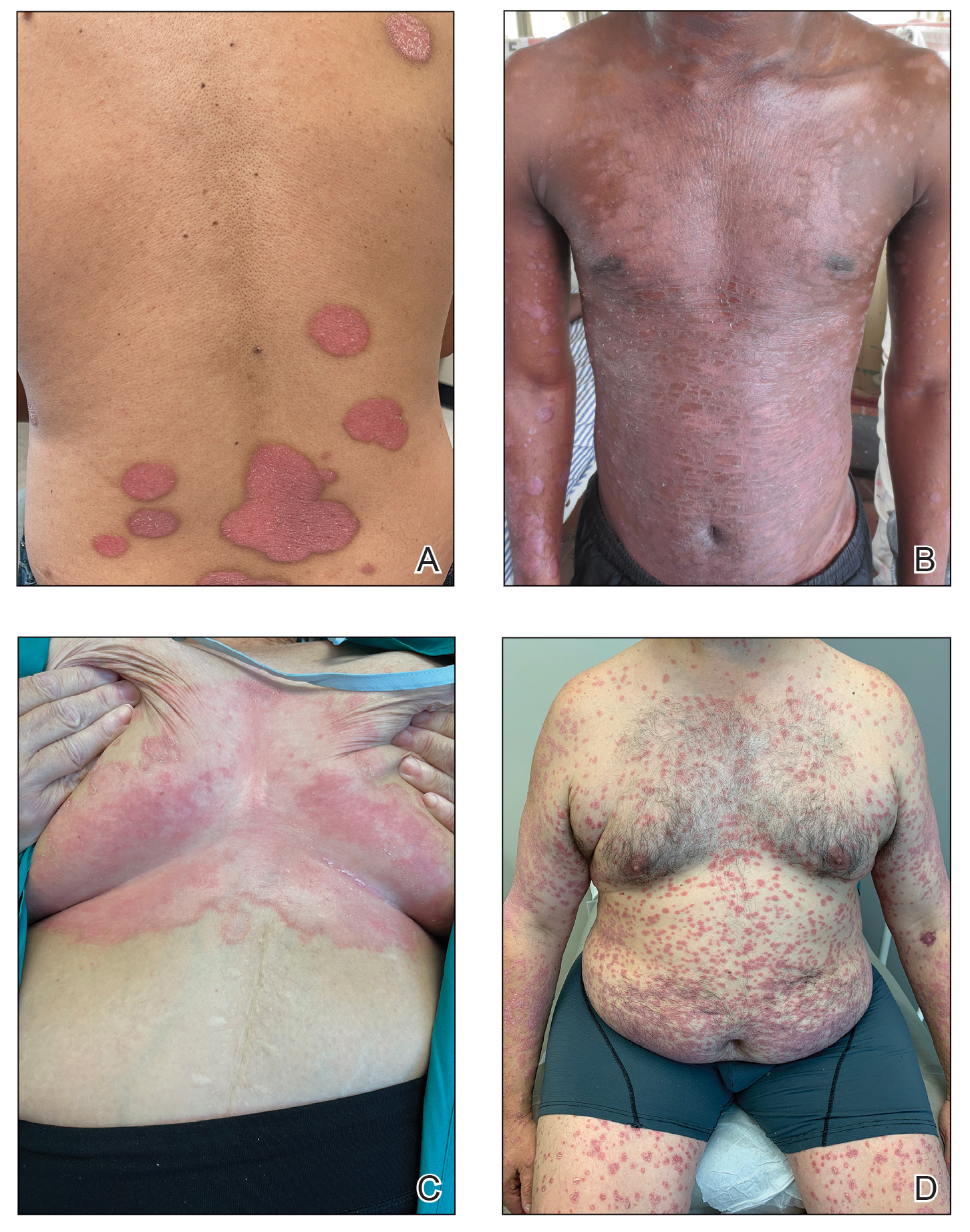 A and B, Characteristic plaque psoriasis of the trunk. C, Inverse psoriasis involving the inframammary folds. D, Guttate psoriasis in an adult following streptococcal infection.