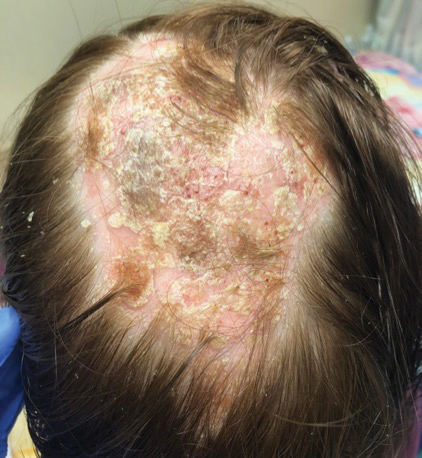 Psoriatic Alopecia in a Patient With Crohn Disease: An Uncommon  Manifestation of Tumor Necrosis Factor α Inhibitors | MDedge Dermatology