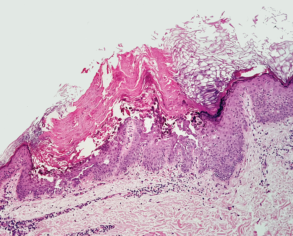 Low Dose Oral Naltrexone For Darier Disease MDedge Low Dose Oral Naltrexone For Darier Disease MDedge