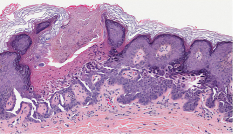 Darier disease. Acantholytic dyskeratosis with corps ronds and grains (H&E, original magnification ×40).