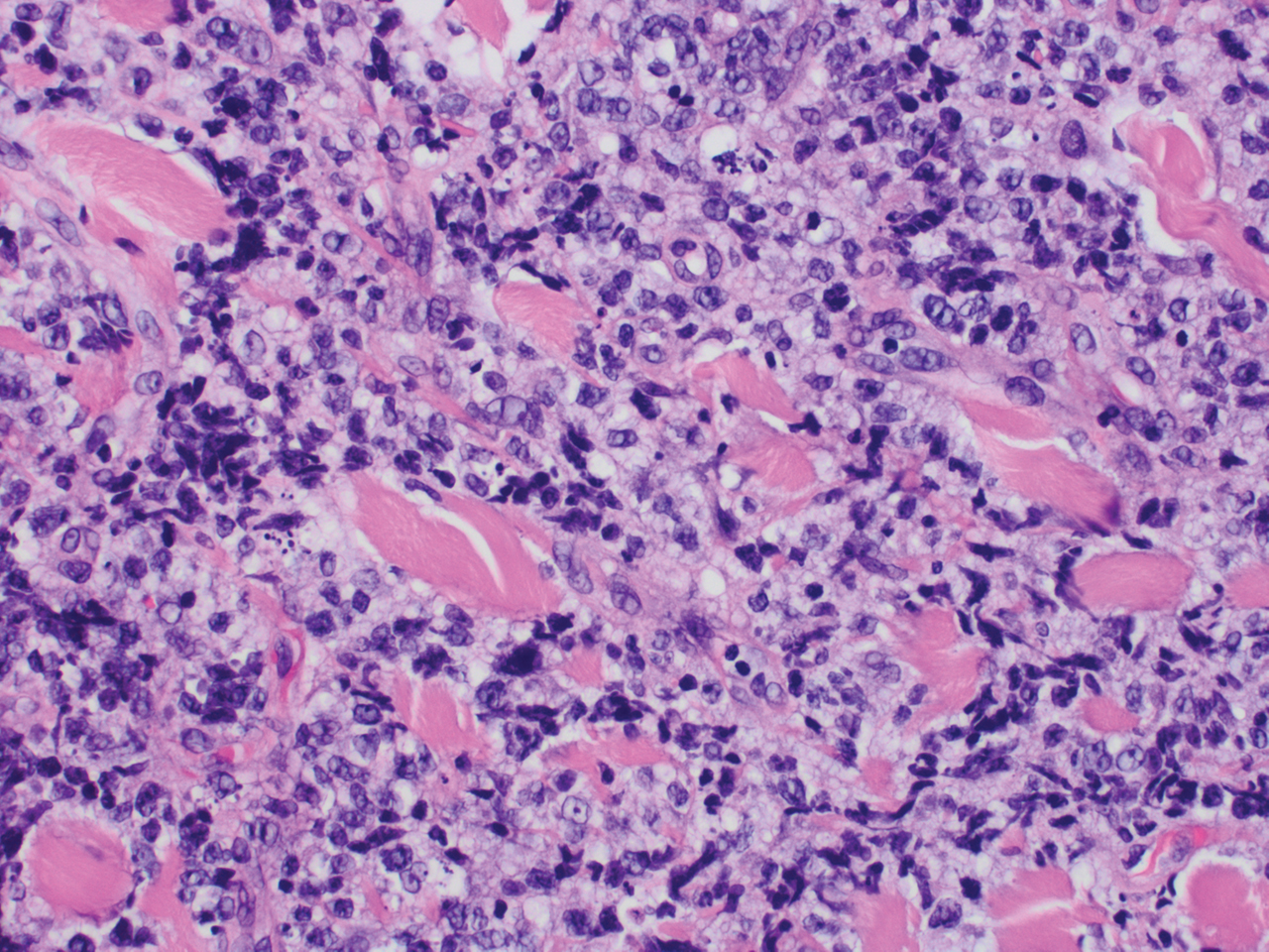 Cutaneous B-cell Lymphoma