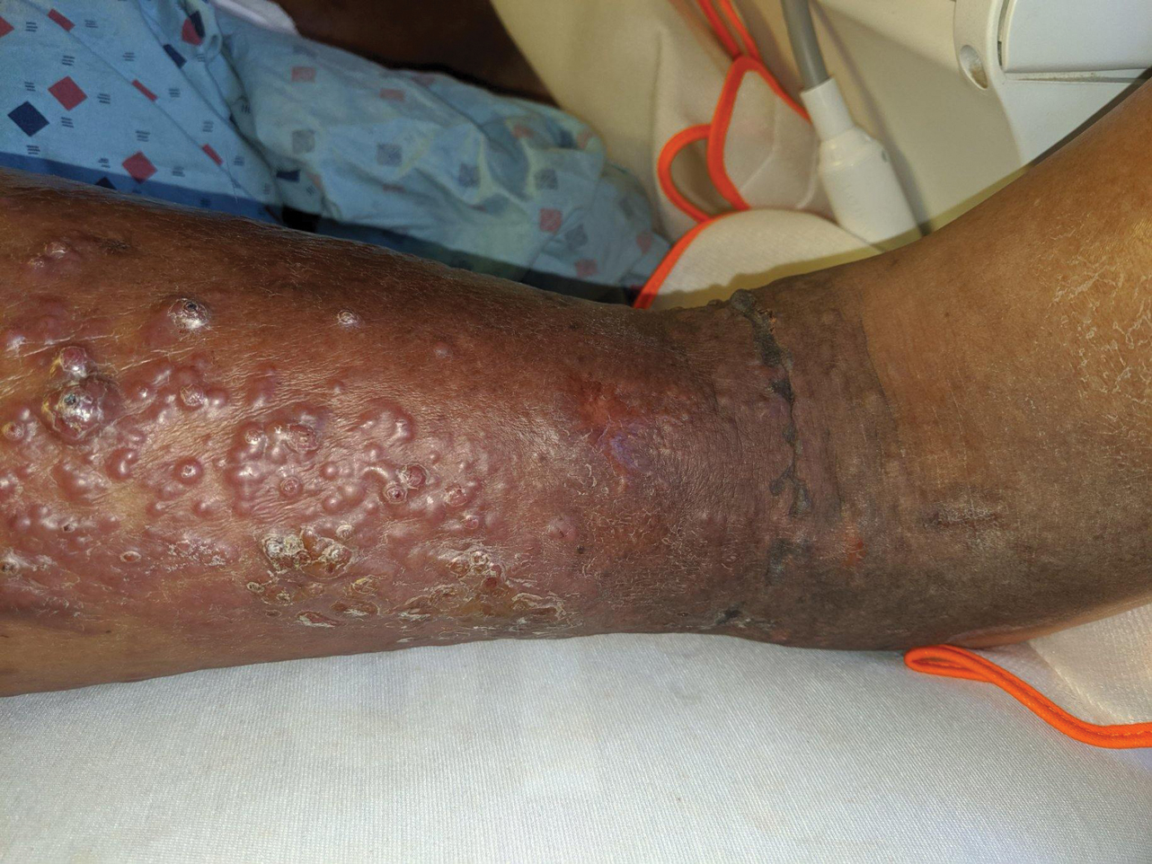 Vesicles and Bullae on the Leg