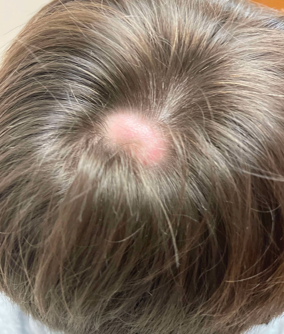 Little Hard Lumps On Scalp Hotsell Cdlguaiba br