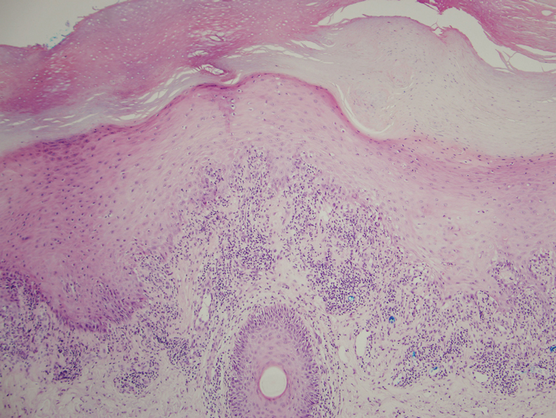 A punch biopsy showed lichenoid interface dermatitis with irregular epidermal hyperplasia