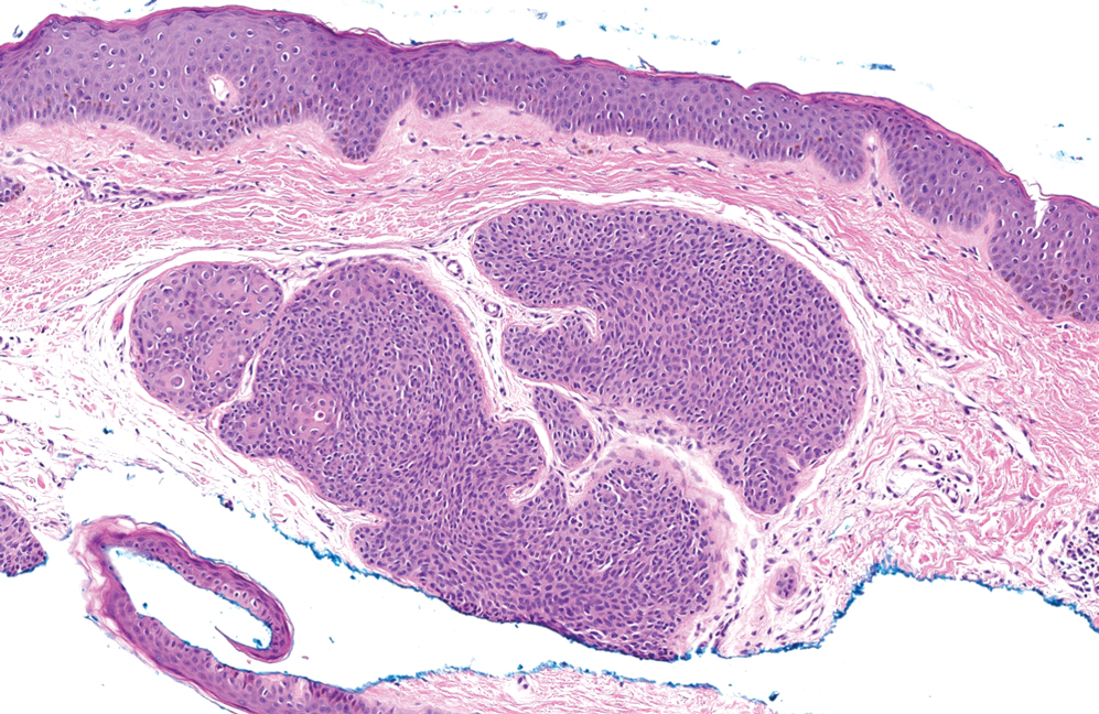 Dermal duct tumors have a relatively eosinophilic appearance due to their cuboidal poroid cells that resemble epidermal keratinocytes punctuated by cuticle-lined ducts