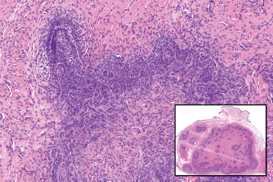 Trichoblastomas have germinative follicular basaloid cells that closely resemble those of basal cell carcinoma but are deepseated tumors with papillary mesenchyme and less stromal mucin