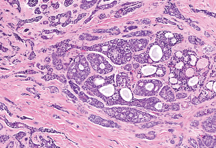 Adenoid cystic carcinoma is composed of cribriform nests and irregular infiltrative trabeculae.