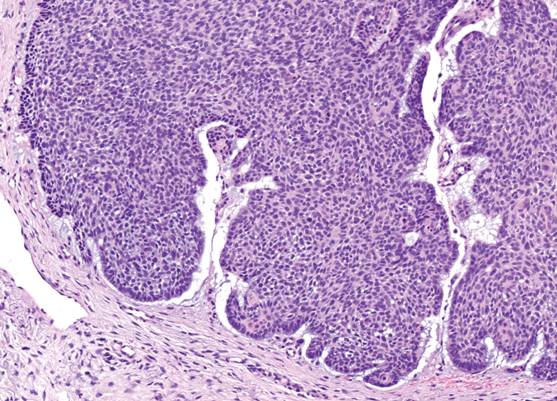 Basal cell carcinoma with nodular morphology is composed of germinative follicular basaloid cells with peripheral palisading and clefts filled with mucin