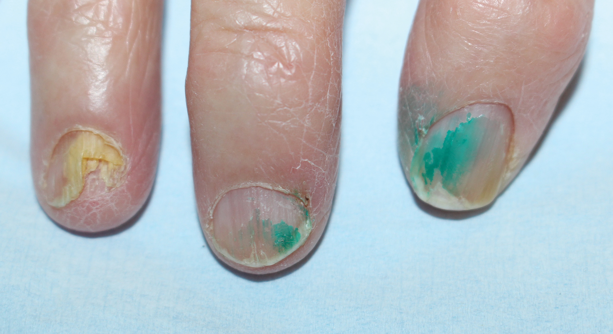 Nail Disorders Due to Environmental, Professional, and Cosmetic Causes and  Auto-induced Nail Diseases | SpringerLink