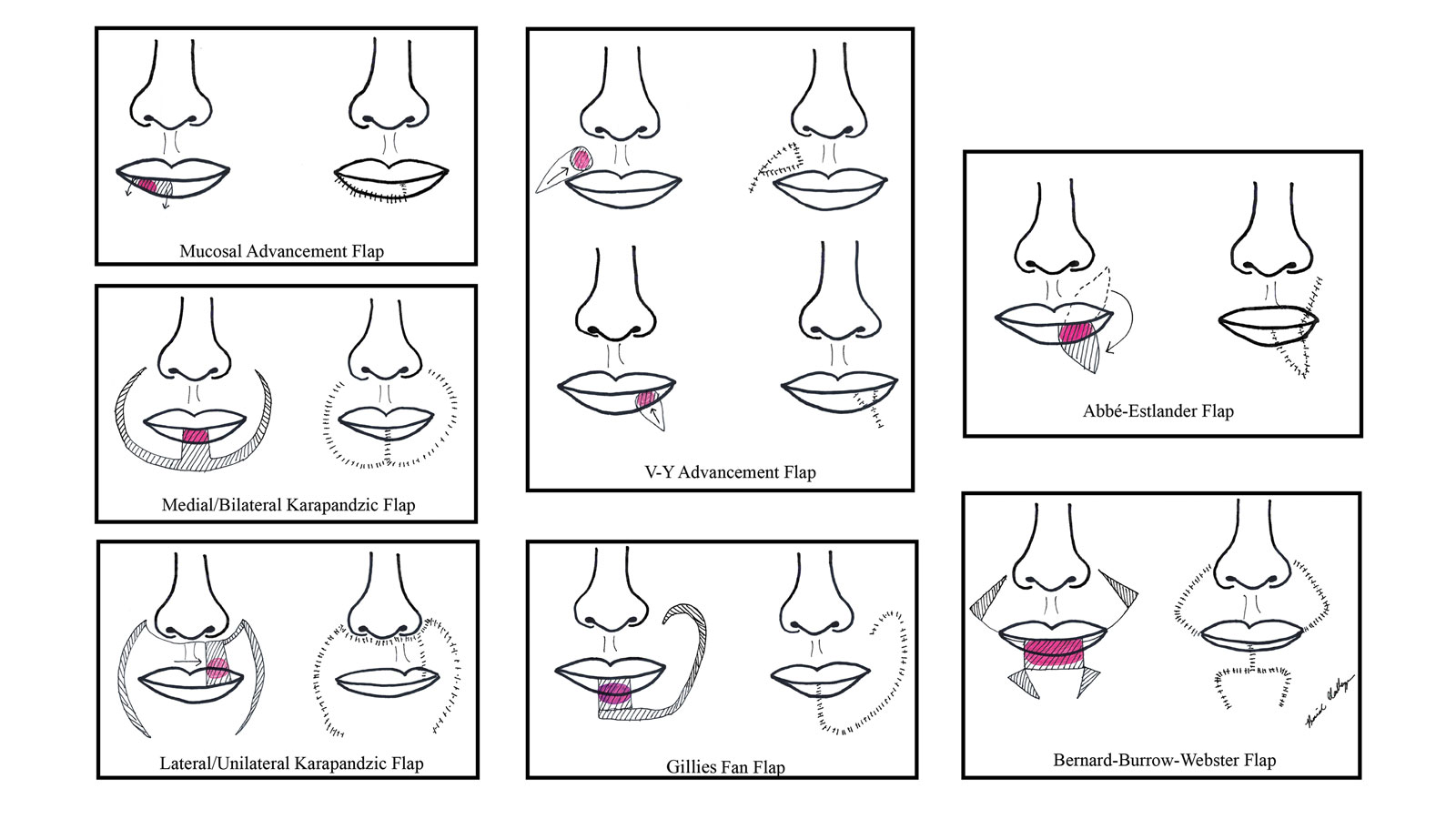 Lip Reconstruction After Mohs Micrographic Surgery: A Guide on Flaps ...