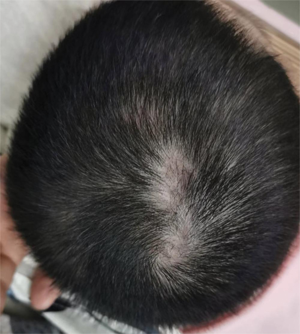 Visible evidence of hair regrowth after 4 weeks of treatment with oral terbinafine for tinea capitis.