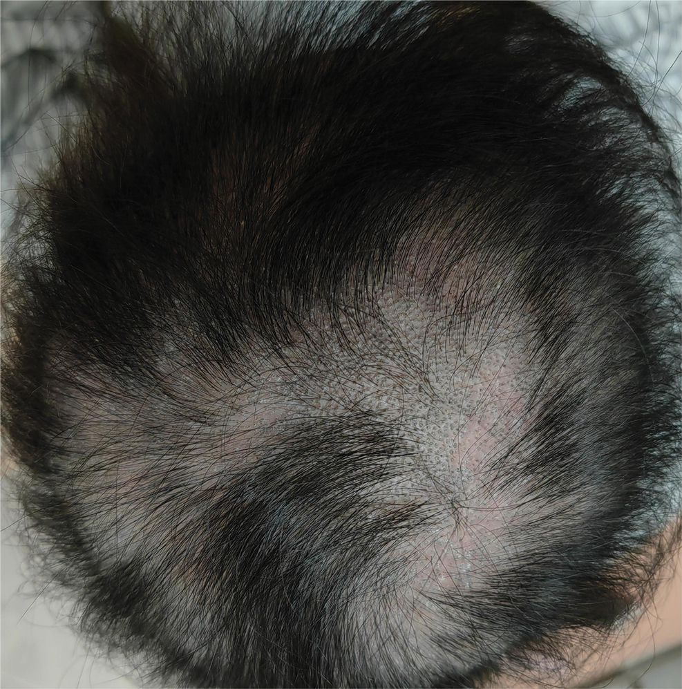 Asymptomatic hair loss