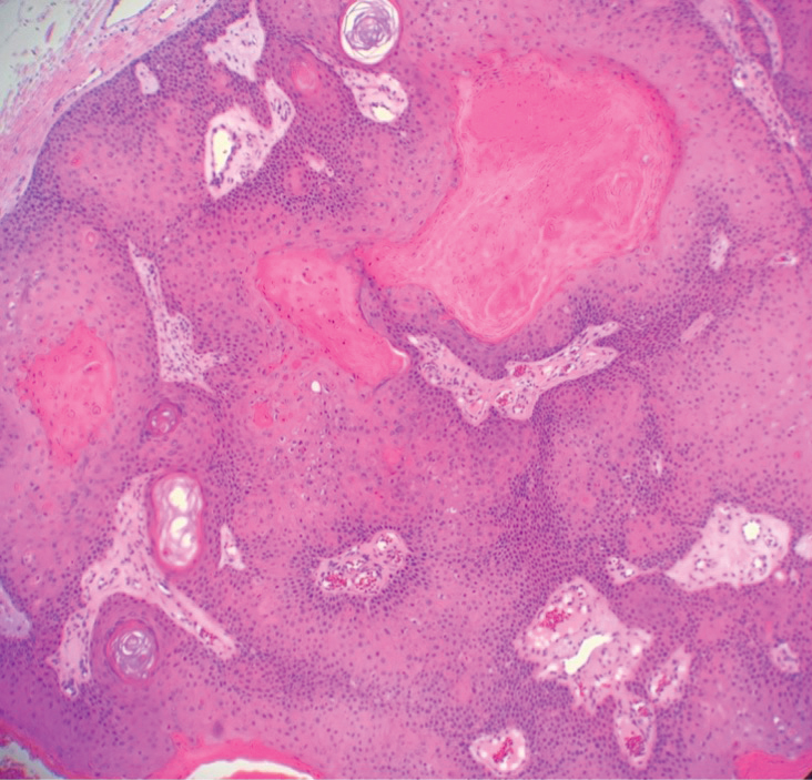 Proliferating pilar cyst with a “rolls and scrolls” pattern of epithelial proliferation containing compact keratin (H&E, original magnification ×40).