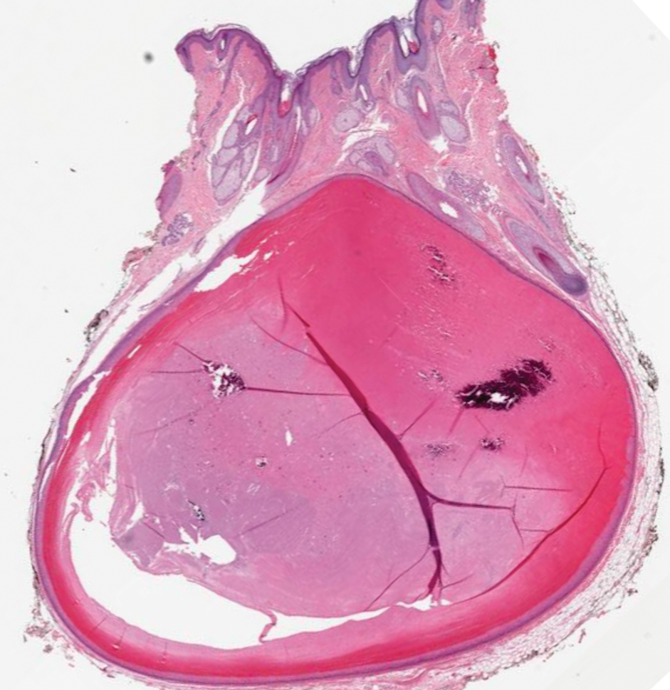 Pilar cyst showing the epithelial lining filled with densely packed eosinophilic keratin (H&E, original magnification ×10).