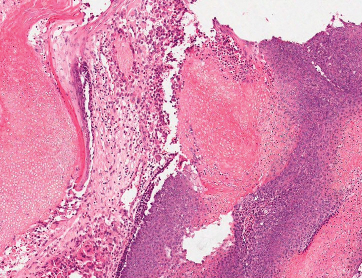 Pilomatrixoma showing a sheet of basaloid cells surrounded by bright pink shadow cells (H&E, original magnification ×40).