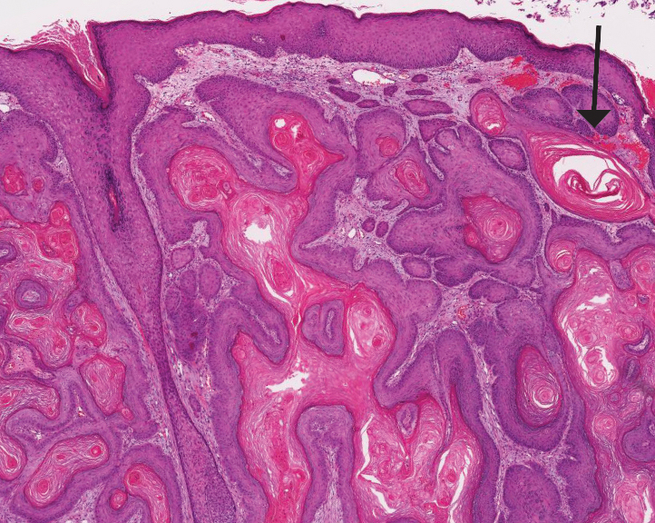 Well-differentiated squamous cell carcinoma showing abundant keratinization with a keratin pearl (arrow) and full-thickness atypia (H&E, original magnification ×20).